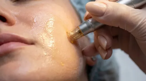 Soin microneedling pour la peau à La Seyne-sur-Mer, La Seyne-sur-Mer, DS Beauté Zen